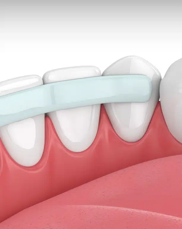 One of the Fastest Ways to Transform Your Smile