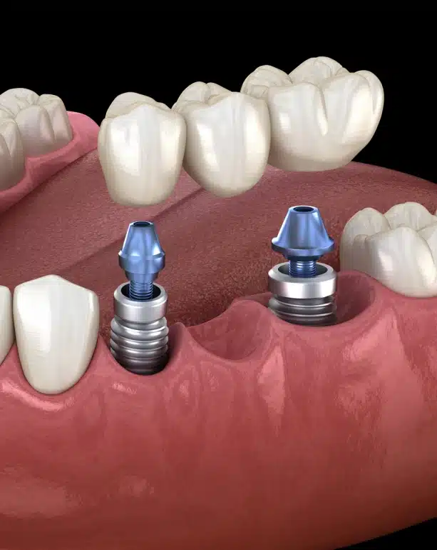 A Stronger, Smarter Way to Replace Missing Teeth in Columbia, TN