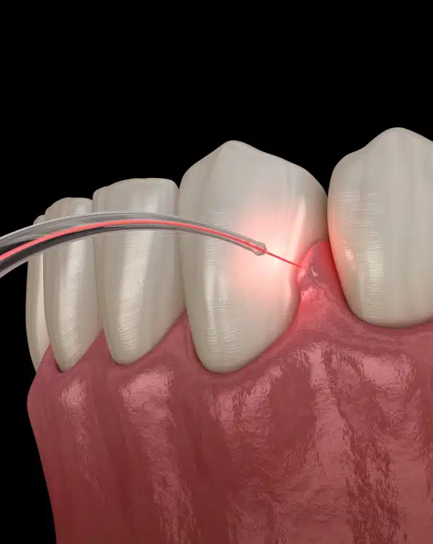 Precision Laser Dentistry Without the Stress