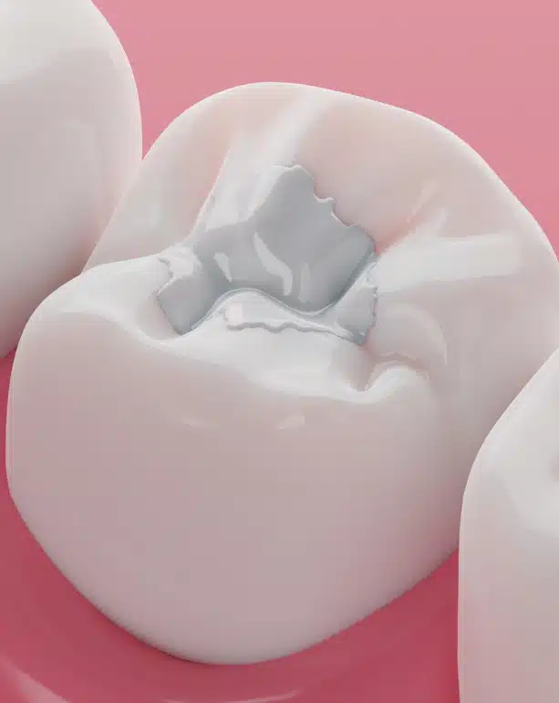 A Healthier, More Beautiful Way to Treat Cavities and Dental Damage